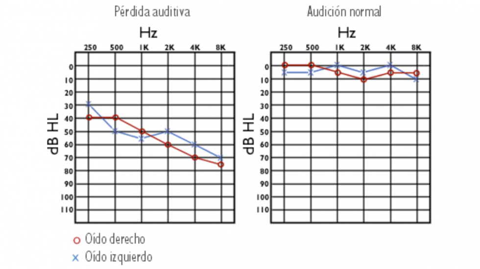 En Que Consiste El Examen De Audiometr A Audia